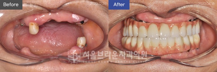 대전치과 대전임플란트 전체임플란트