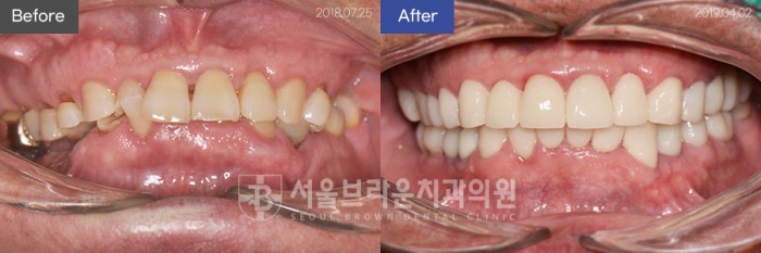 대전치과 대전임플란트 전체임플란트