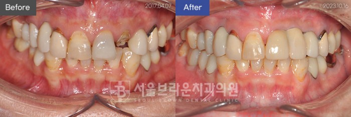 대전치과 대전임플란트 앞니임플란트 전체임플란트