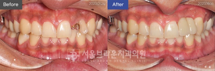 대전치과 대전임플란트 앞니임플란트 전체임플란트