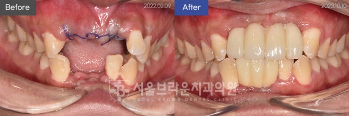 대전치과 대전임플란트 앞니임플란트 전체임플란트