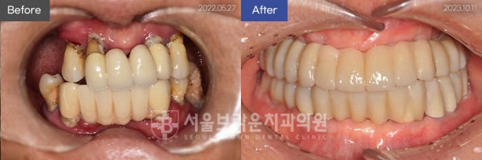 대전치과 대전임플란트 전체임플란트 앞니임플란트
