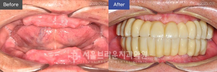 대전치과 대전임플란트 전체임플란트 앞니임플란트
