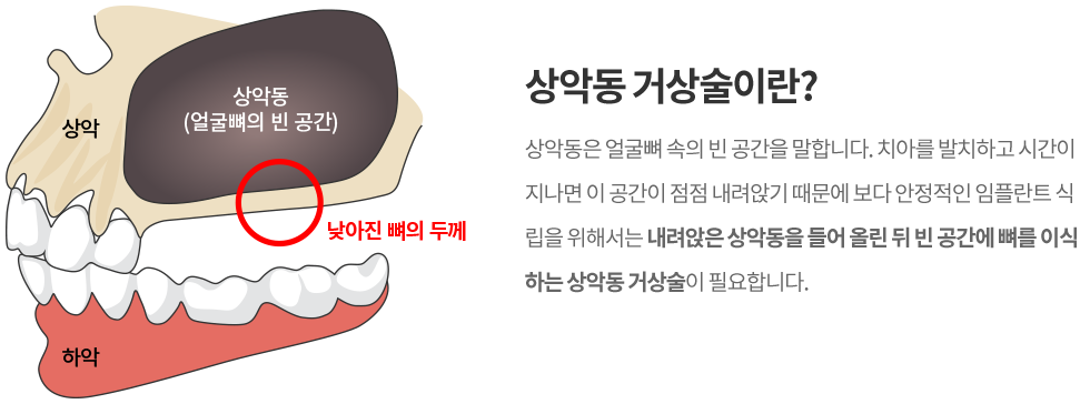 상악동 거상술이란?