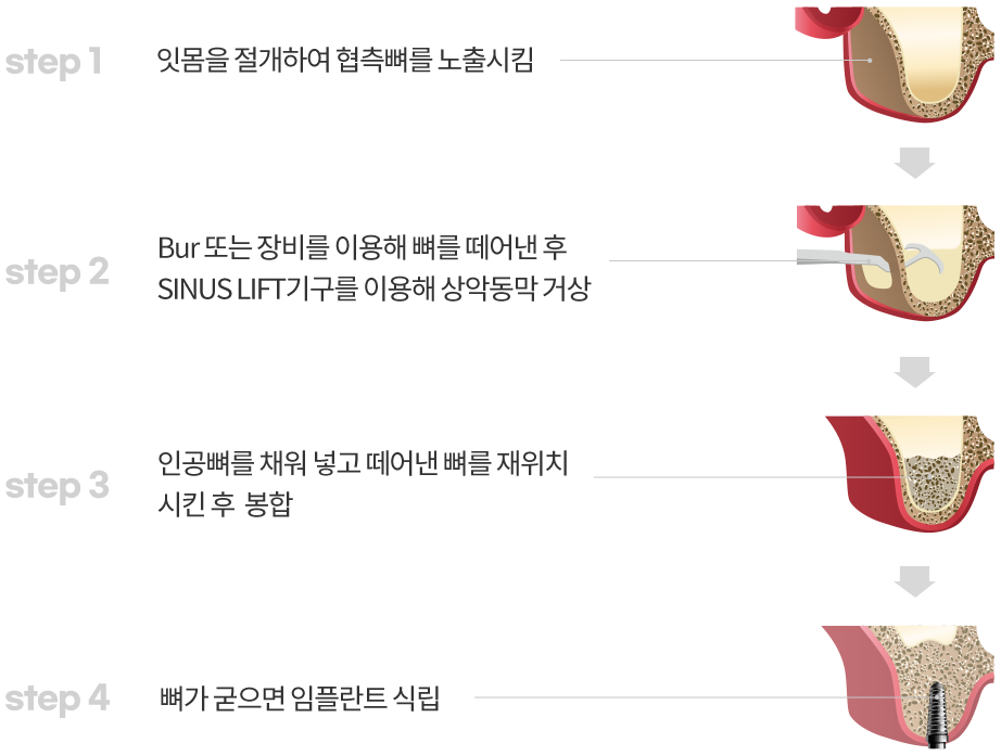 상악동 거상술 치료과정