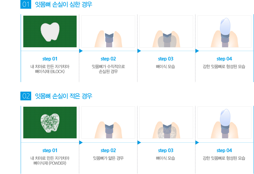 대전자가치아뼈이식의 수술과정