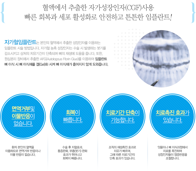 대전 자가혈 임플란트