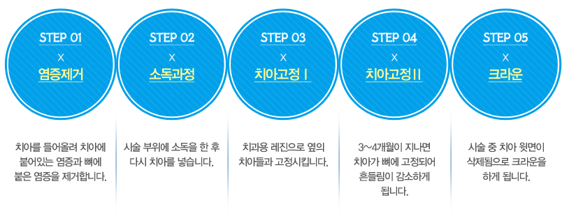 대전치아재식술 진행단계