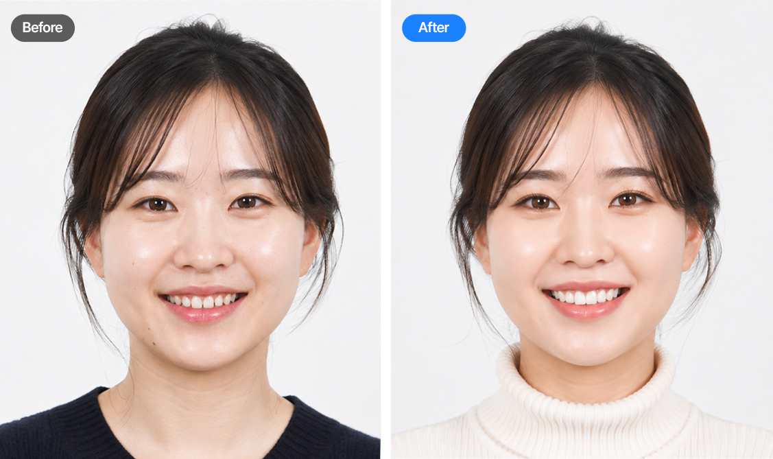 대전라미네이트 치료 전후