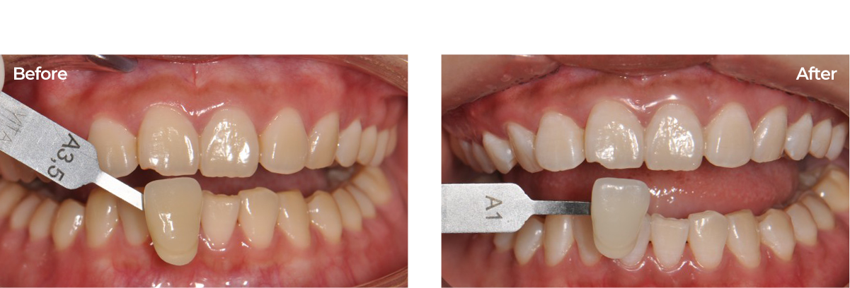 치아미백 전후사진.20대여성 전문가미백 1회 진행