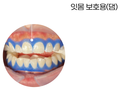 대전치아미백 서울브라운치과