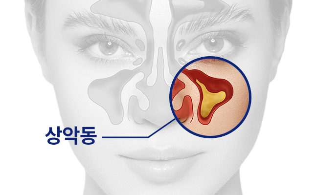 상악동이란