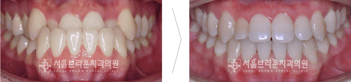 대전치아교정 전후 사진