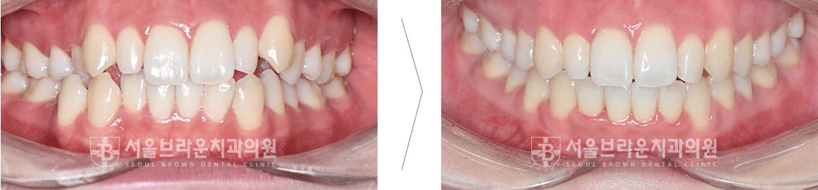 대전치아교정 전후 사진