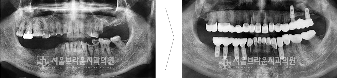 대전 임플란트 전후 사진