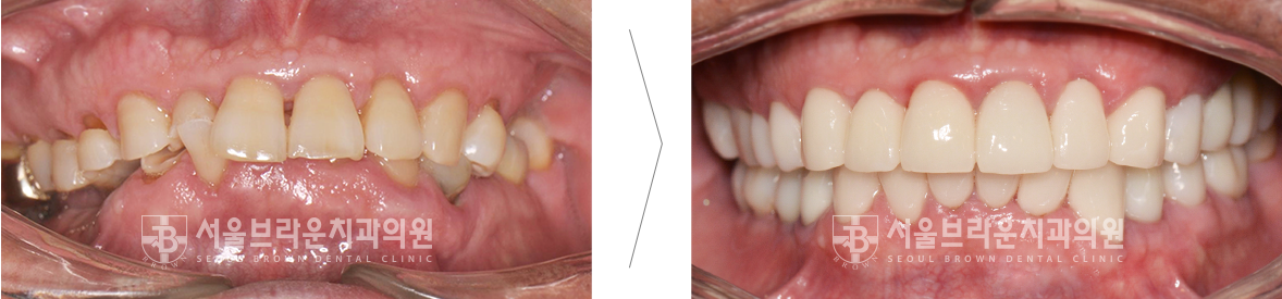 대전 임플란트 전후 사진