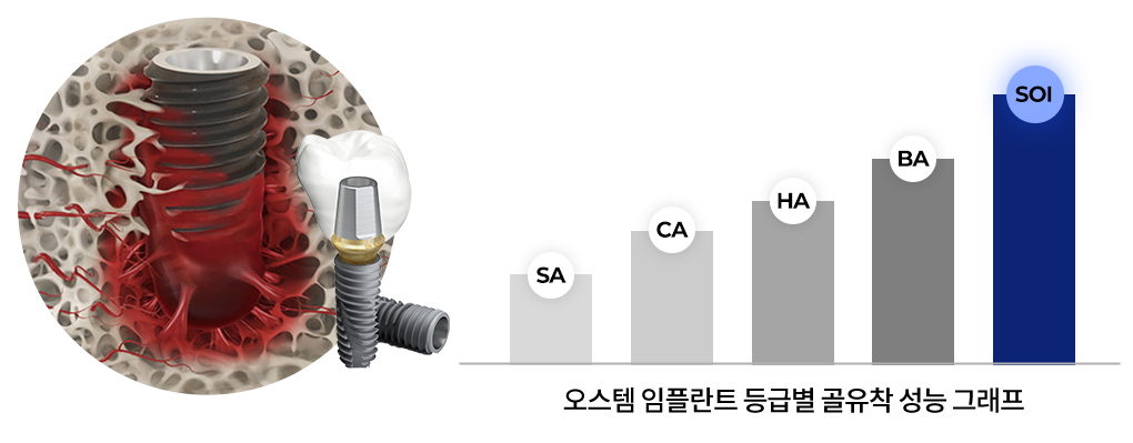 대전 임플란트 오스템 soi등급 사용